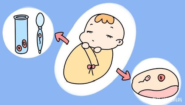 多囊卵巢综合征