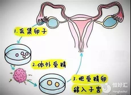 多囊卵巢综合征