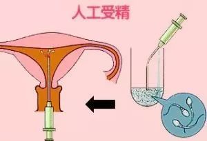 人工授精