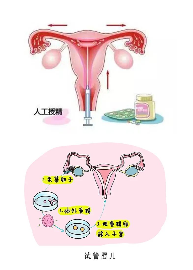 人工授精