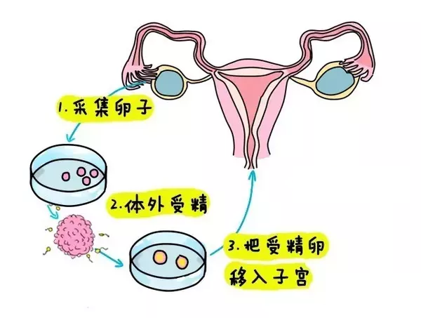 人工取卵子