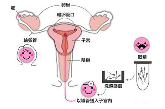 人工授精